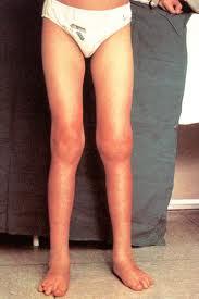 Cuidados en la Artritis crónica juvenil