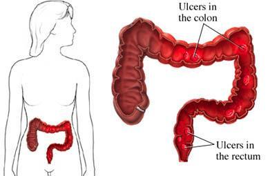 ¿Qué es la colitis ulcerosa?