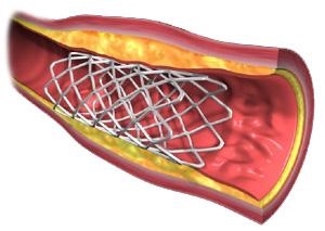 Stent coronarios reabsorbibles