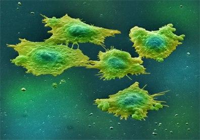 ¿Es hereditario el cáncer?