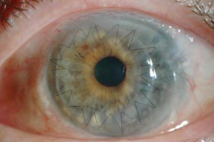 Cirujanos en EU realizan el primer trasplante de ojo completo del mundo