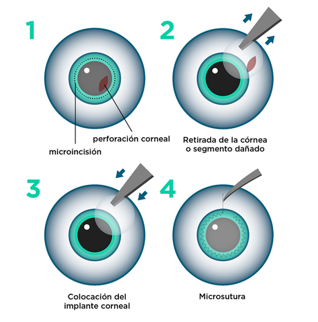 Cirujanos en EU realizan el primer trasplante de ojo completo del mundo