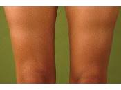 Lipoatrofia Semicircular