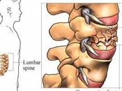Fracturas vertebrales