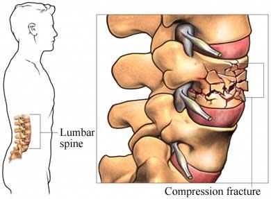 Fracturas vertebrales