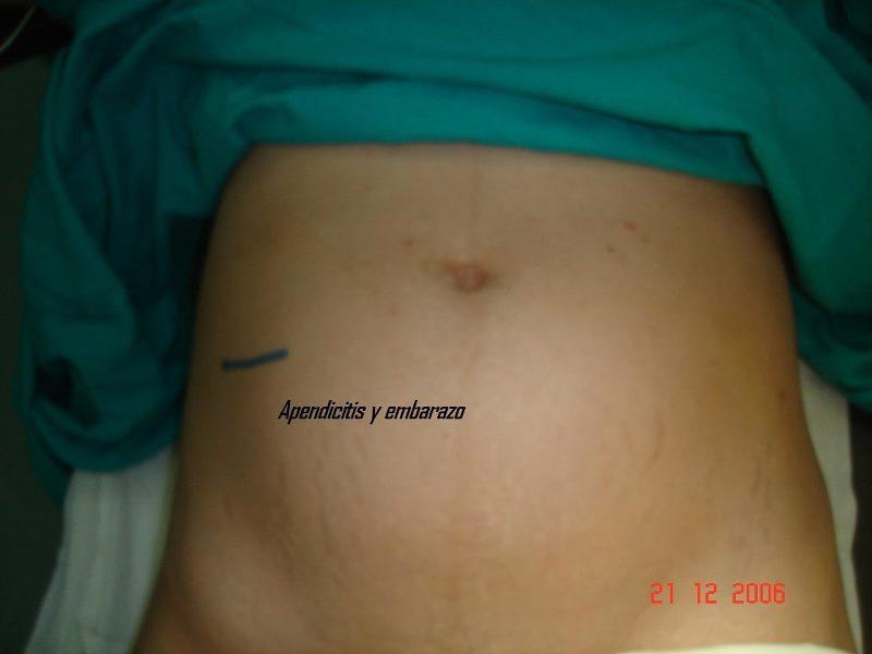Apendicectomía durante el embarazo