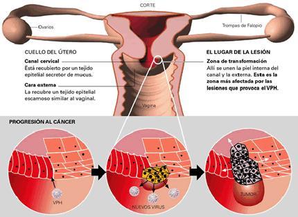 Cáncer de cuello uterino y VPH