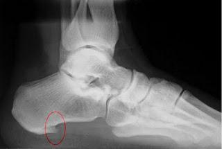 EL ESPOLÓN CALCANEO FISIOTERAPIA TERVE LUCHA CANARIA