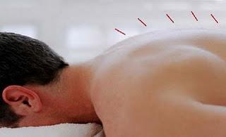 Acupuntura para dejar de fumar Acupuntura para dejar de fumar