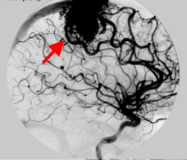 Malformaciones arteriovenosas cerebrales, ¿qué hacer?