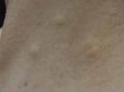 Hidrocistomas ecrinos múltiples localización atípica