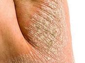 estigma psoriasis