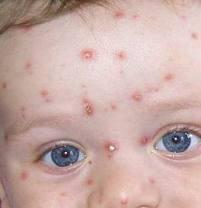 varicela ¿Qué es la varicela?