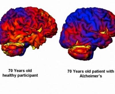 Tamaño del cerebro para predecir la enfermedad de Alzheimer