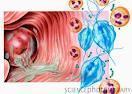 Vulvovaginitis.