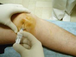 Infiltraciones intraarticulares de ácido hialurónico en rodillas con artrosis
