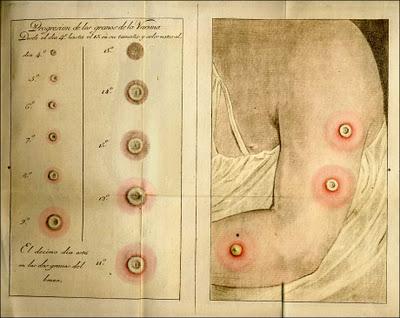 EXPEDICIÓN FILANTRÓPICA DE LA VACUNA