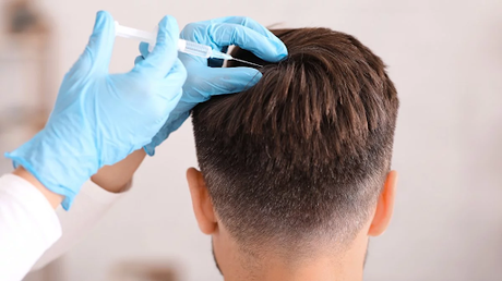 Innovación en terapia capilar: botox contra la calvicie.