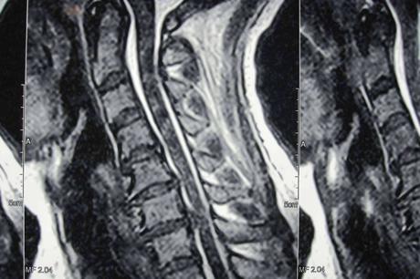 ¿Qué es la hernia disco cervical?, por Neurocirugía Galarza