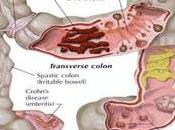 Limpieza intestinal