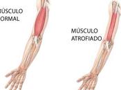 ¿Qué distrofias musculares?