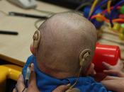 niños sordos evolucionarían mejor doble implante coclear