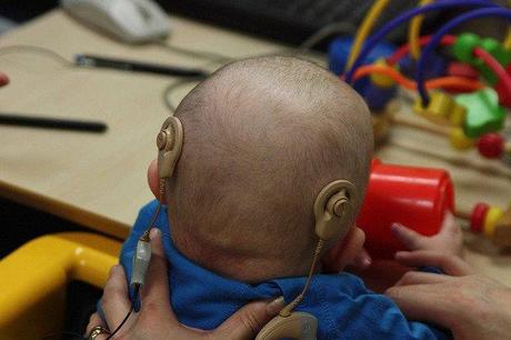Los niños sordos evolucionarían mejor con doble implante coclear