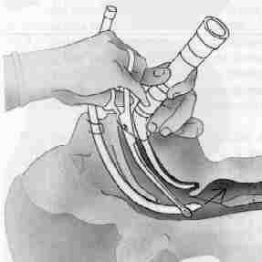 Disfunción deglutoria después de intubación prolongada