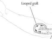fístula arteriovenosa después trasplante