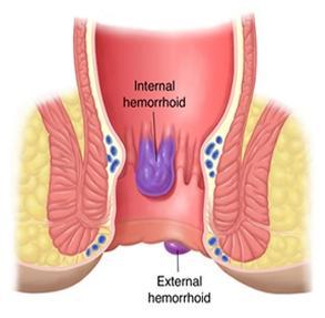 henorroides tratamiento Hemorroides: Tratamiento