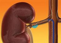 La Denervacion Renal Mejora la Hipertension Arterial