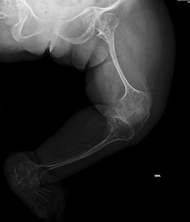 Identifican un nuevo gen responsable de la osteogénesis imperfecta