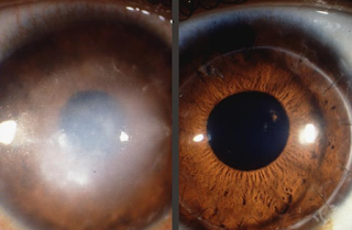 Edema corneal depués de la cirugía de catarata.