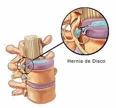 ¿Se puede curar la hernia discal?