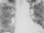 Fibrosis pulmonar bajo lupa…