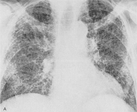 Fibrosis pulmonar bajo la lupa…