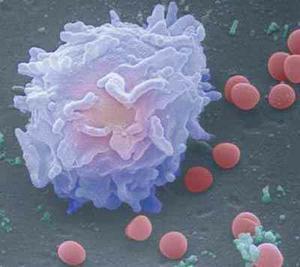 Reflexiones: Leucemia, el cáncer de la sangre