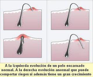 ¿Qué son los pelos encarnados o vellos encarnados? Consejos para evitar los pelos encarnados