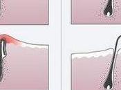 ¿Qué pelos encarnados vellos encarnados? Consejos para evitar