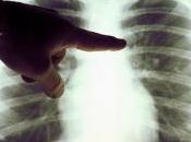 escaneo rayos parece prevenir cáncer pulmón