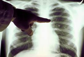  El escaneo por rayos X parece no prevenir el cáncer de pulmón