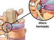 ¿Qué disco herniado?