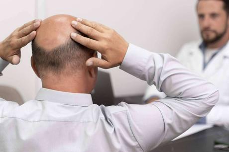 Las causas de la calvicie en España Las causas de la calvicie en España