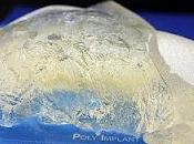 Informe preliminar sobre implantes mamarios