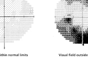 Cómo examen glaucoma