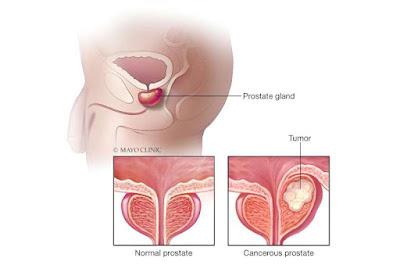 Avances en la cirugía robótica para tratar cáncer de próstata