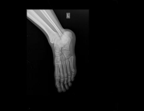 fractura proximal del 5to metatarsiano fractura proximal del 5to metatarsiano