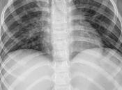 Datos incipientes bronconeumonia