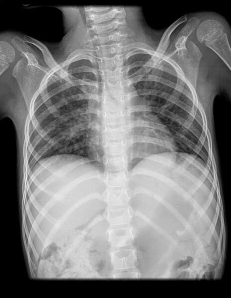 DATOS INCIPIENTES DE BRONCONEUMONIA