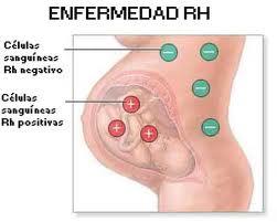 La enfermedad Rh en el embarazo